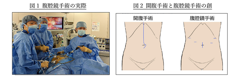 【図1 腹腔鏡手術の実際】　【図2 開腹手術と腹腔鏡手術の創】
