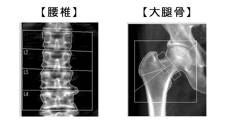 腰椎・大腿骨
