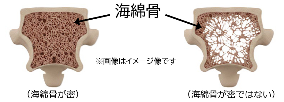 海綿骨イメージ図