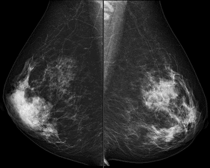 トモシンセシス(3Dマンモグラフィ)撮影