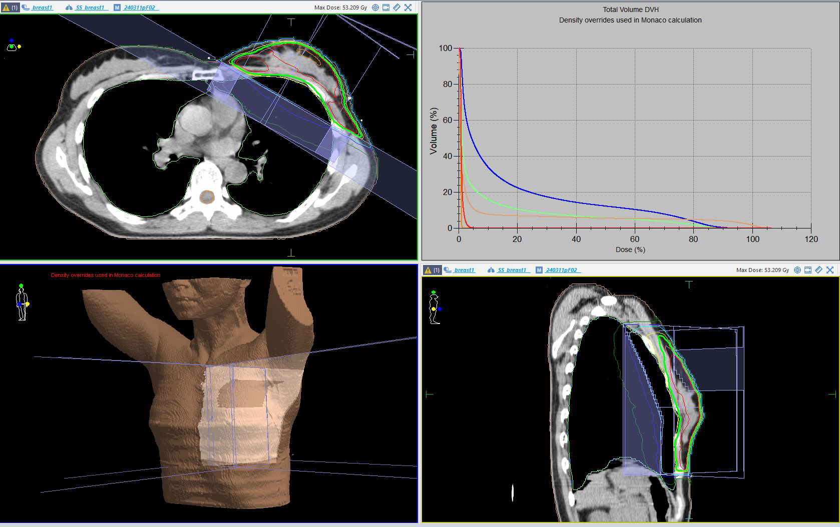 当院の放射線治療計画装置(Monaco)で作成した乳房接線照射の一例